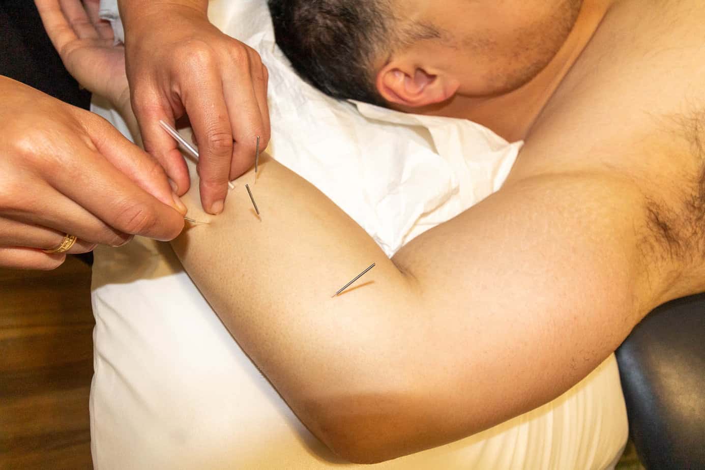 Physiotherapy Como dry needling neck treatment