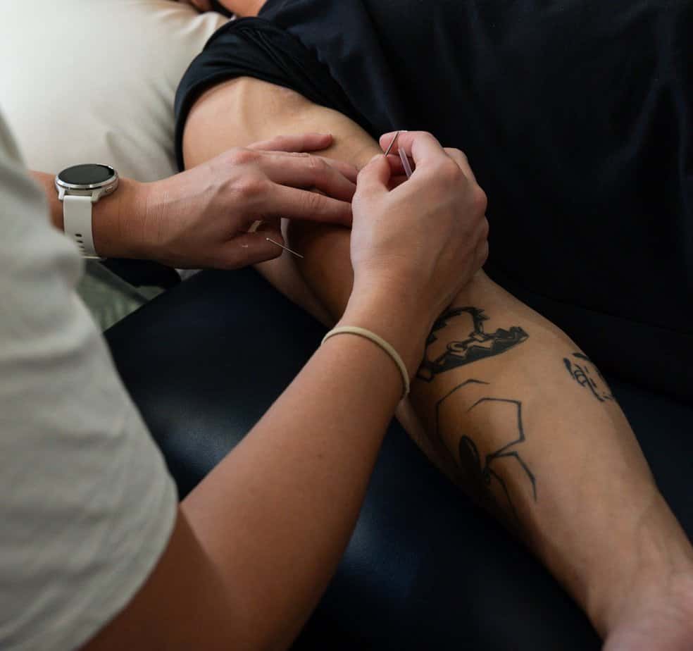 Physiotherapy Brentwood dry needling arm treatment
